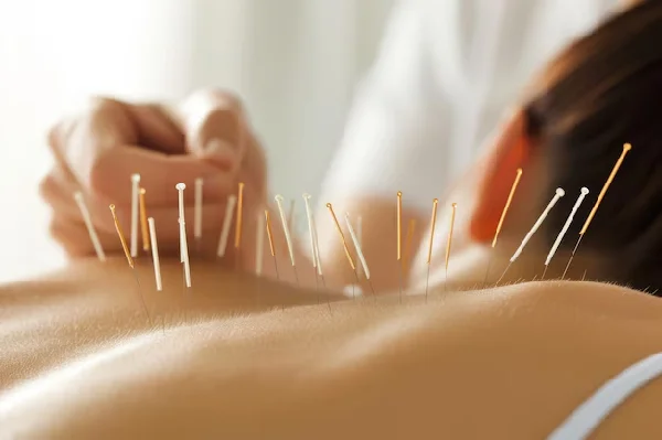 Acupuncture